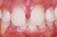 矯正歯科医による前歯の間がすき間だらけの矯正歯科治療例