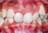 矯正歯科医による噛み合わせが深く奥歯があたると下の前歯が見えない方の矯正歯科治療例