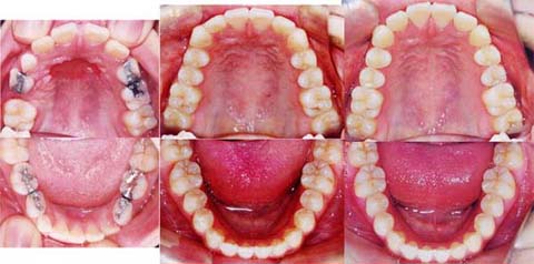 矯正歯科における抜歯治療と非抜歯治療・中立の立場から・・・