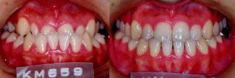 矯正歯科医による受け口の矯正歯科治療前後の歯ならびの変化