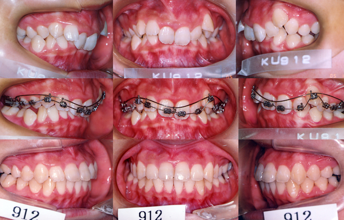 深い噛み合わせ症例の矯正歯科治療前後の比較