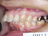 矯正歯科医による成人女性骨格性上顎前突の矯正歯科治療例