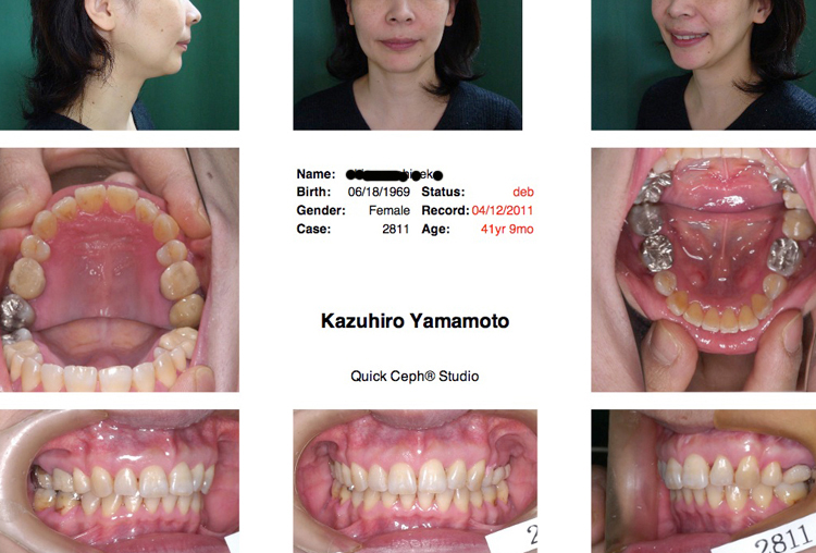 「成人女性の骨格性上顎前突の矯正歯科医による矯正歯科治療結果」