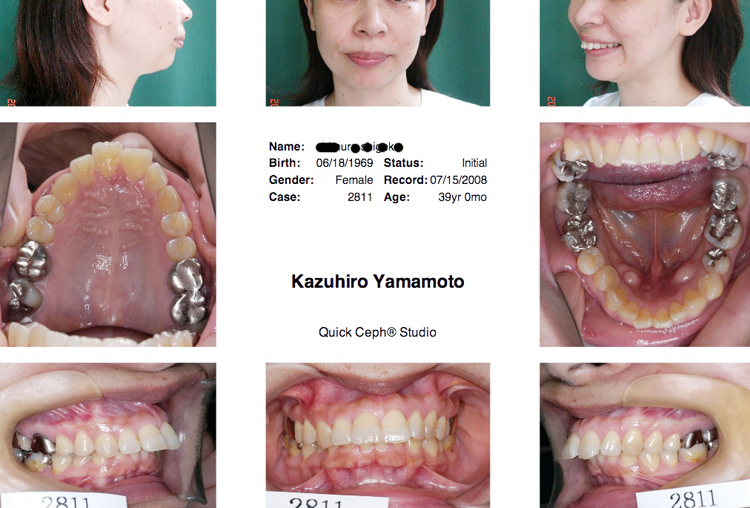 「矯正歯科治療＝成人女性の骨格性上顎前突の矯正歯科治療前」