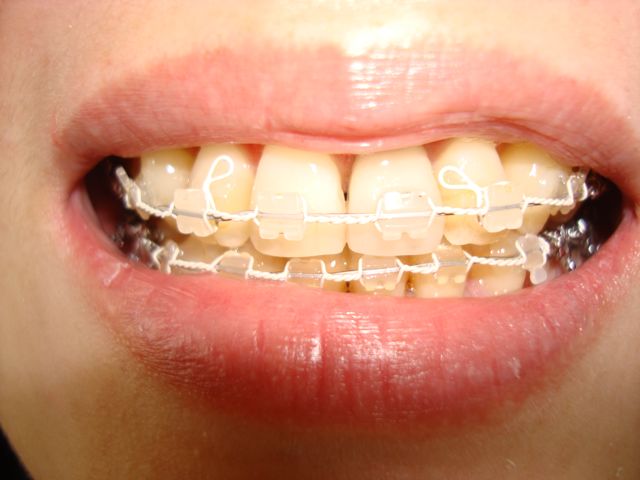 セラミック・ホワイトワイヤー矯正歯科装置用純白のフック
